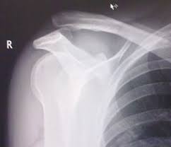 signs of a broken collarbone