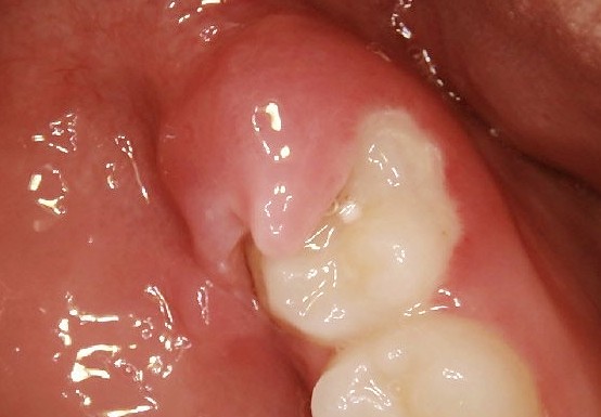 Should I Remove My Partially Erupted Wisdom Tooth New Health Advisor