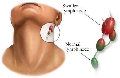 Can Allergies Cause Swollen Glands New Health Advisor