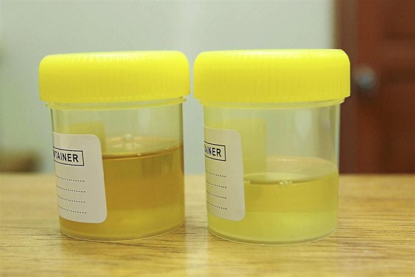 Is It Normal To Have Urine In Bright Yellow Color New Health Advisor