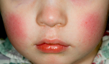 What Causes Red Blotches On Baby Face After Eating New Health Advisor