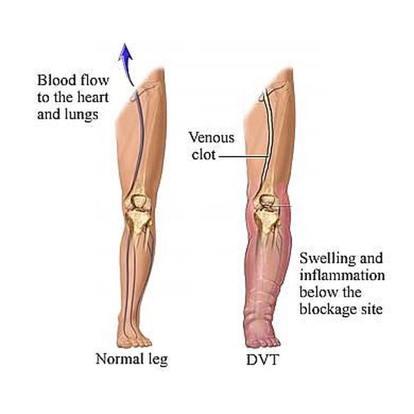 9 Home Treatments For Blood Clots In Your Leg New Health Advisor