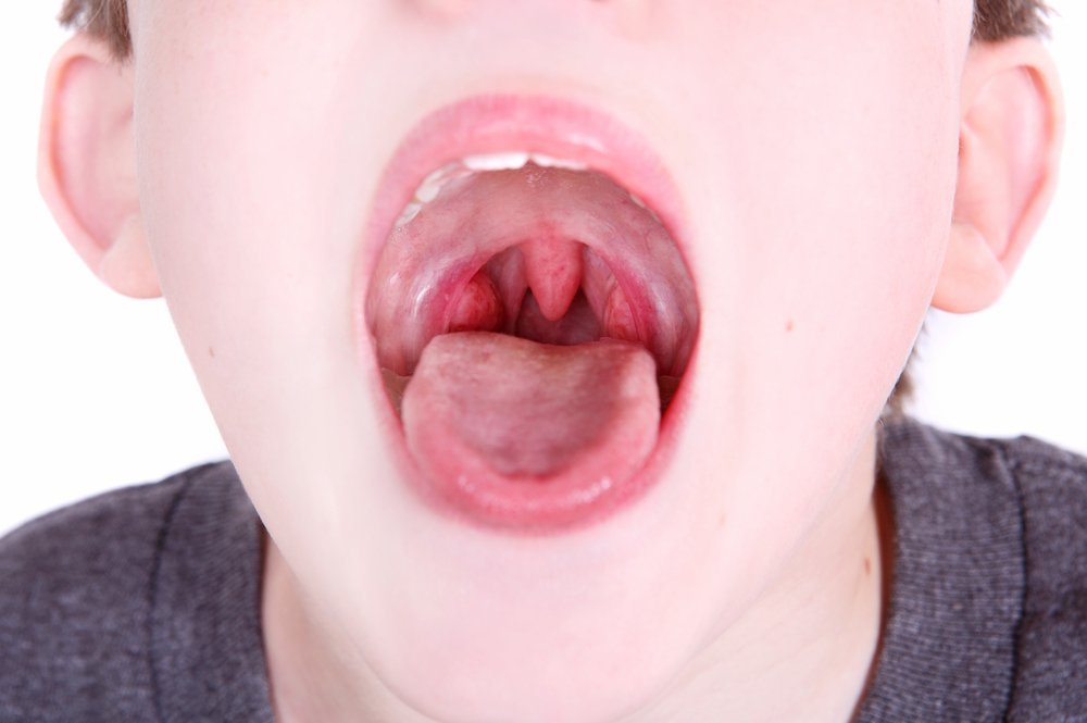 vetor-do-stock-tonsils-and-throat-diseases-tonsillitis-symptoms