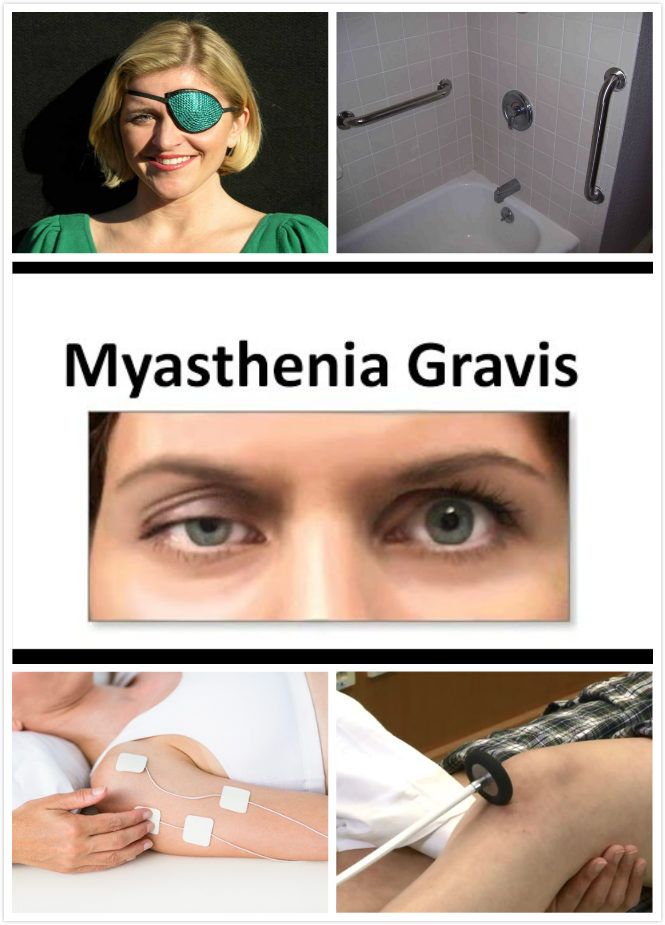 Myasthenia Gravis Diagnosis New Health Advisor 4098
