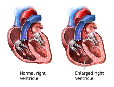 Tricuspid Regurgitation: Causes, Symptoms, Treatment 