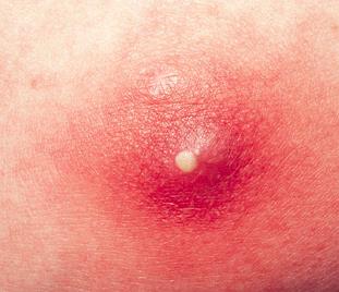 Are Abscesses Contagious? | New Health Advisor