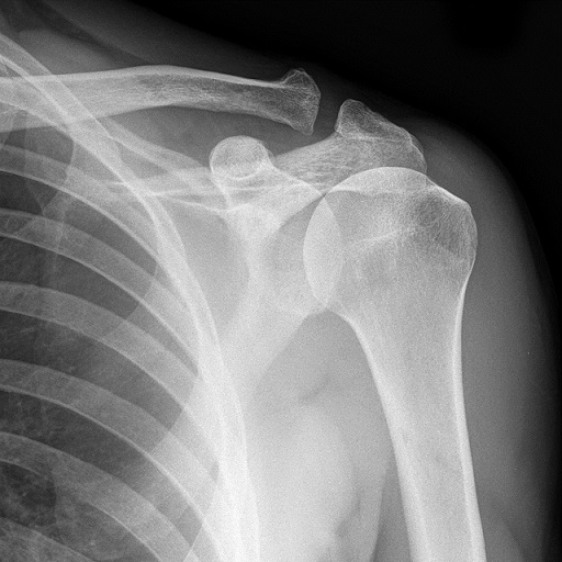 Shoulder Dislocation X Ray | New Health Advisor