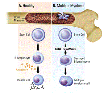 Multiple Myeloma Stages | New Health Advisor