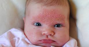 6 Explanations To Small Bumps On Baby Face New Health Advisor