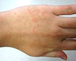 Causes and Treatment of Small Red Bumps on Hands | New Health Advisor