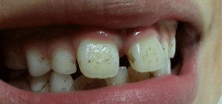 Why Do I Have Black Stains On Teeth New Health Advisor