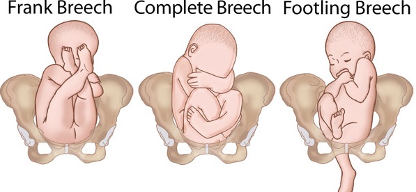 Breech Baby at 32 Weeks