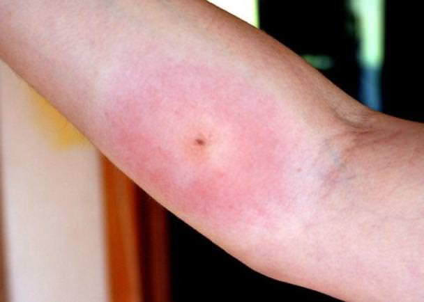 Bug Bite With White Ring Around It TSMP Medical Blog