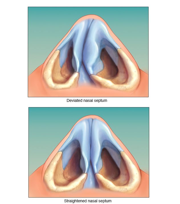 Home Remedies and Medicines for Deviated Septum (No Surgery) | New ...