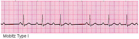 What Is 2nd Degree Heart Block? | New Health Advisor