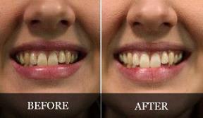 Oil Pulling Before and After | New Health Advisor