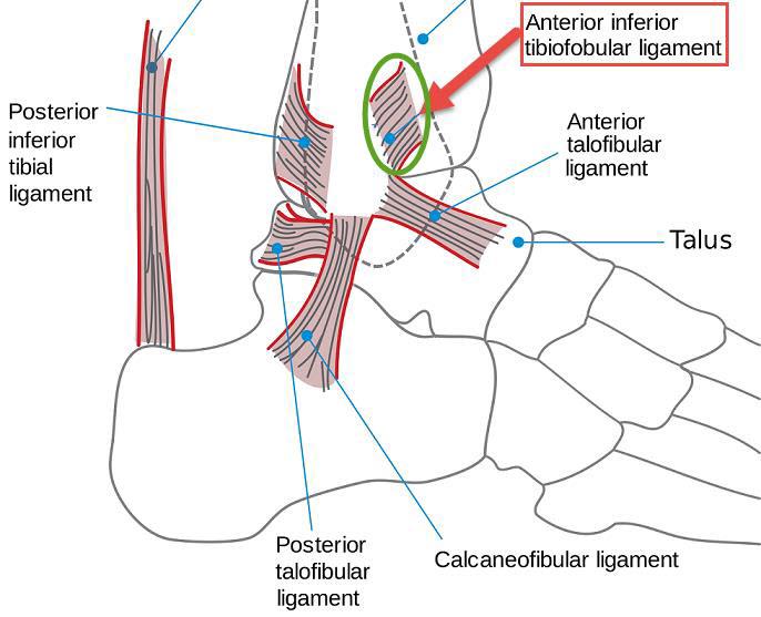 Anterior Tibiofibular Ligament Injury and Treatment | New Health Advisor