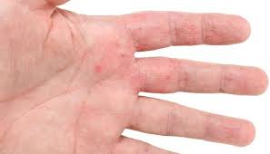 Causes and Treatment of Small Red Bumps on Hands | New Health Advisor