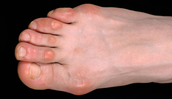 Lumps on Toes | New Health Advisor